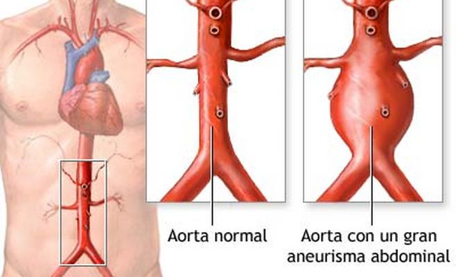 Aneurisma abdominal_658x400