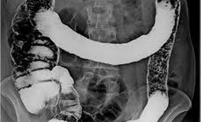 Colitis Ulcerosa_658x400