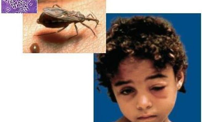 Mal de Chagas