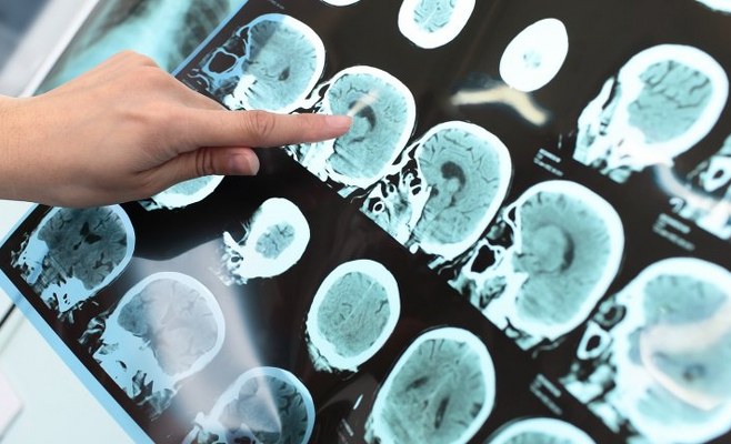 Alzheimer